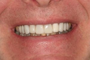 Tetracycline Makeover After