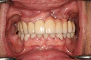 Full Mouth Restoration After
